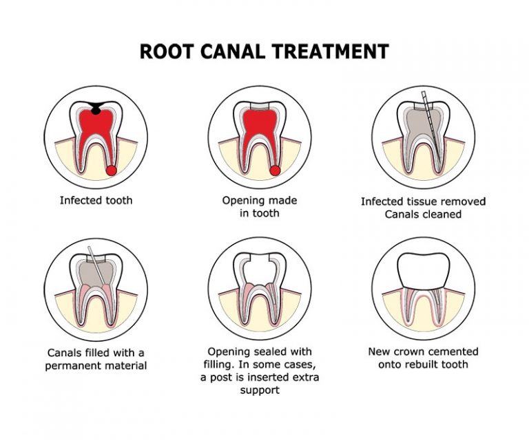 Root Canal Treatment