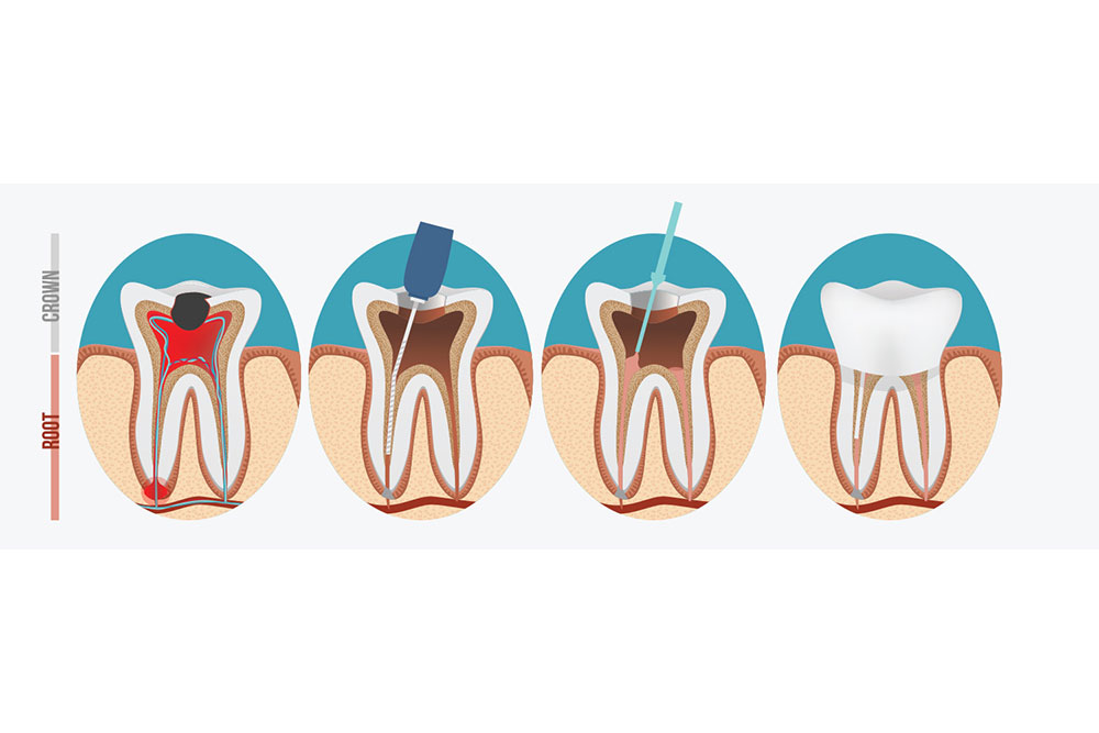 root-canal-therapy